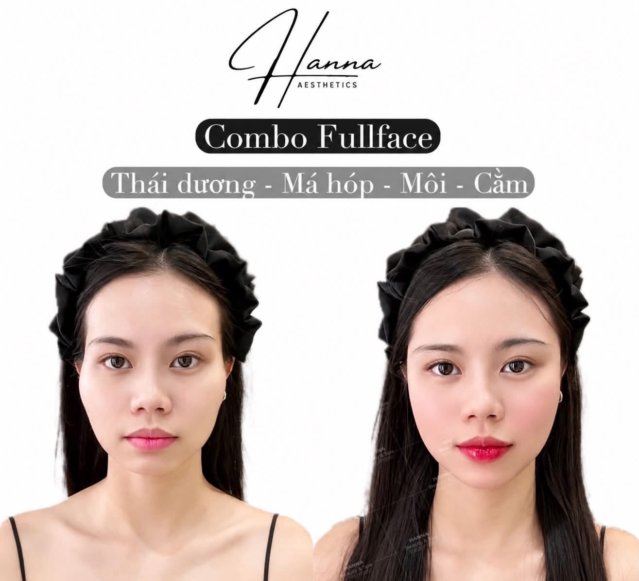 Case thực tế Combo Fullface trước và sau