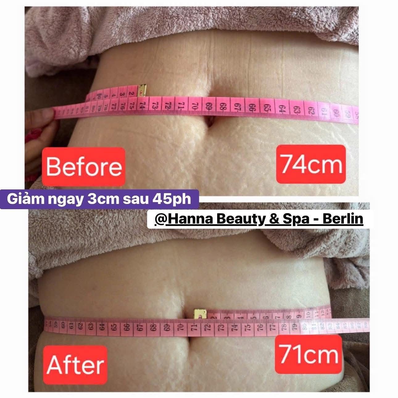 Vòng eo trước 74cm và sau 71cm sau 45 phút tại Hanna Beauty & Spa Berlin