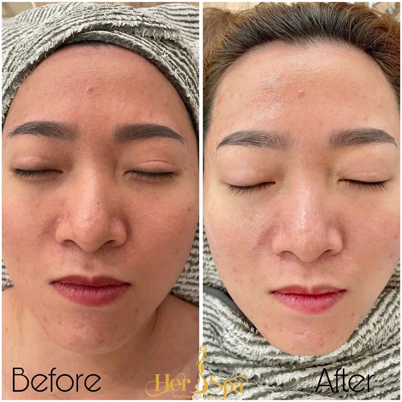 Da mặt trước và sau một buổi chăm sóc tại Her S Spa: da sáng, căng bóng