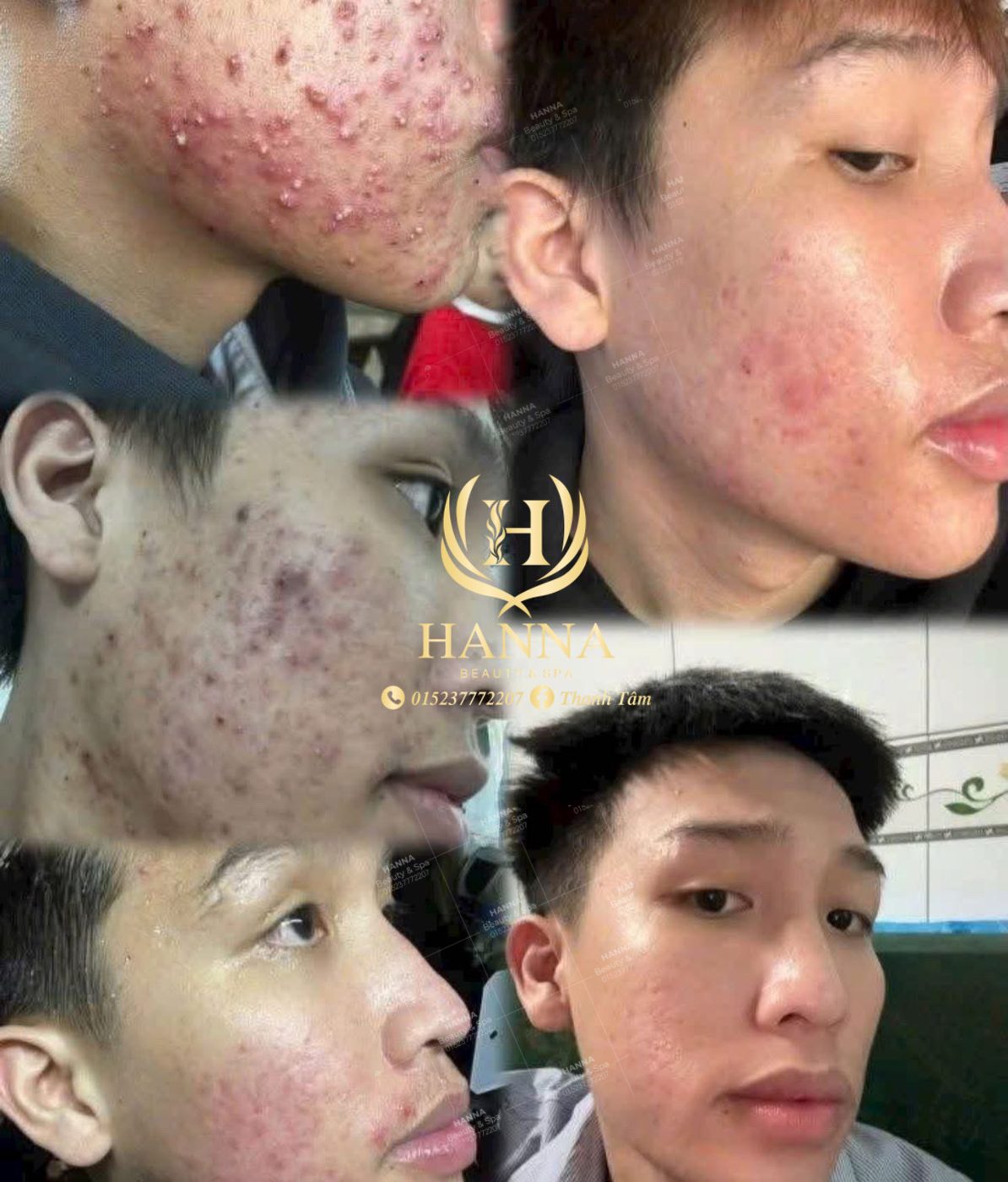 Mụn viêm, mụn mủ dày đặc hai bên má, sau liệu trình da sạch mụn