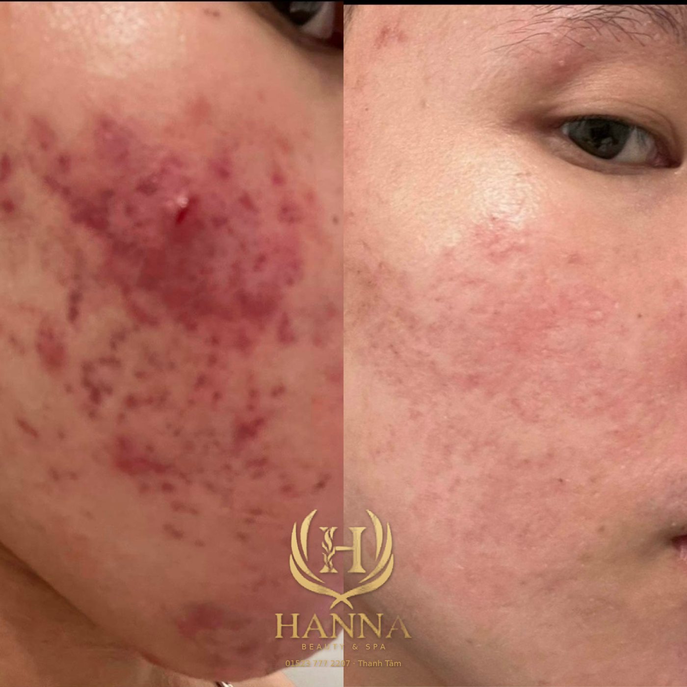 Mụn viêm và thâm đỏ dày đặc vùng má, sau liệu trình da sạch mụn, thâm mờ