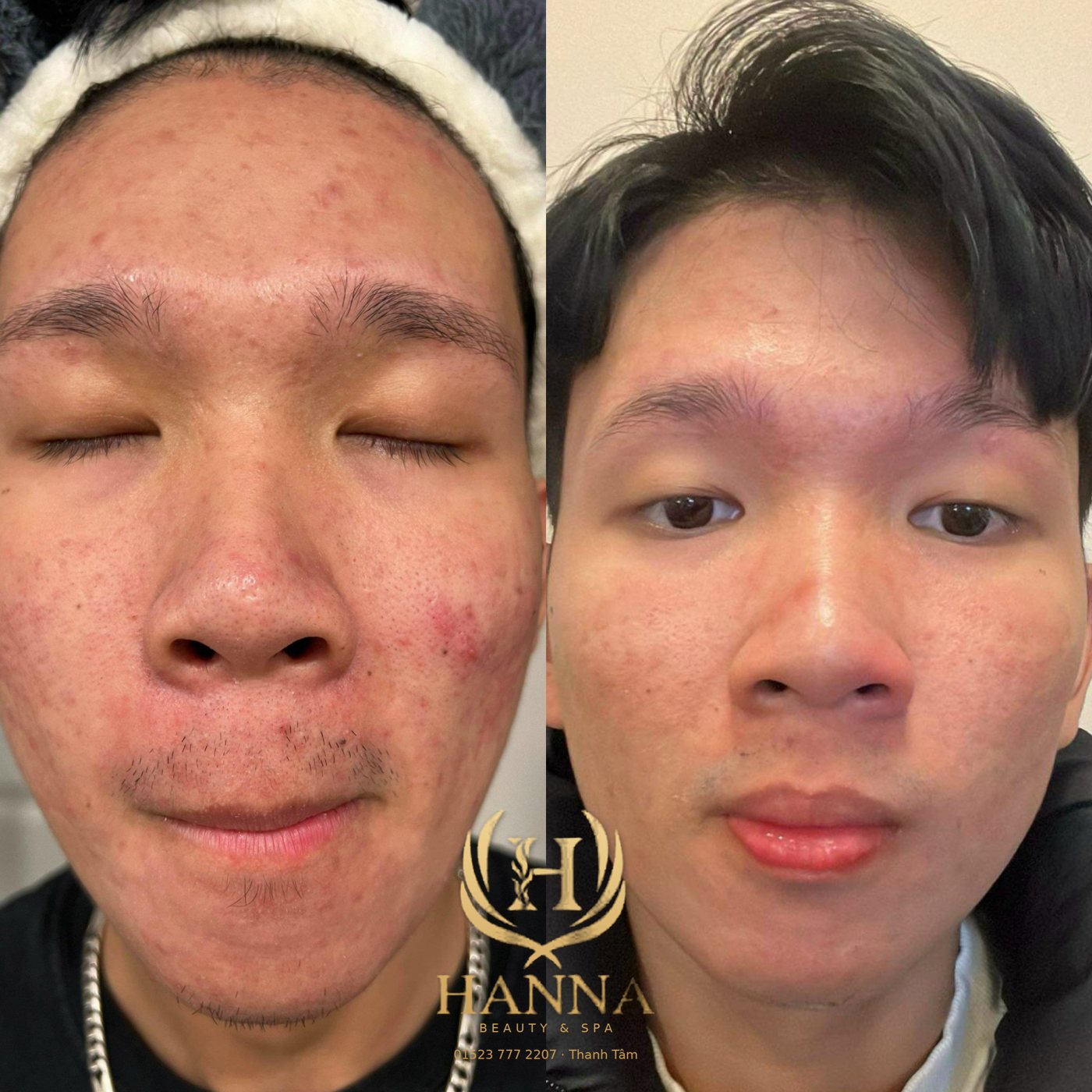 Mụn viêm và da đỏ toàn mặt ở nam giới, sau liệu trình da sạch và đều màu