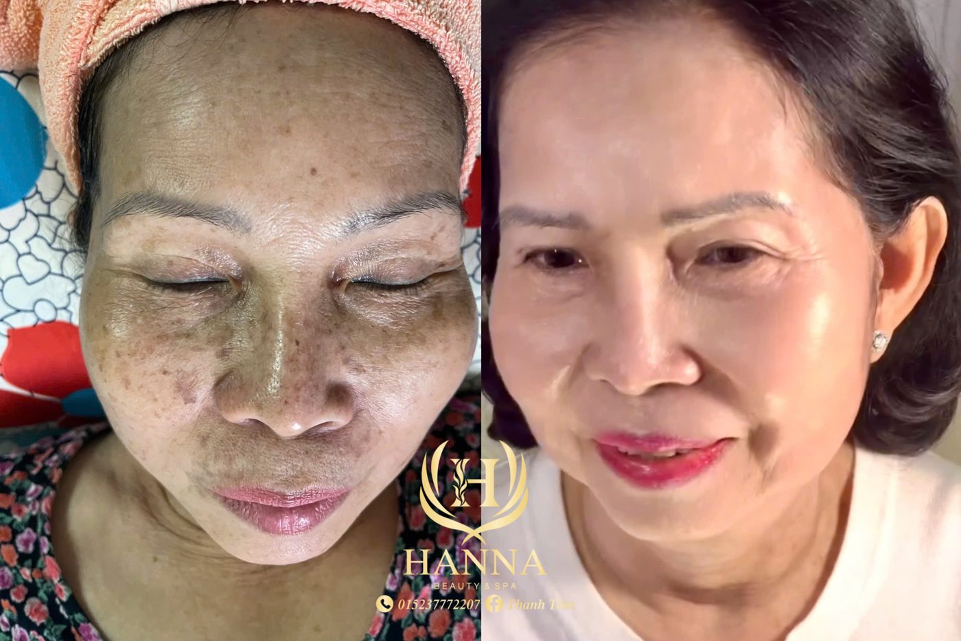 Da nám và sạm trước và sau liệu trình