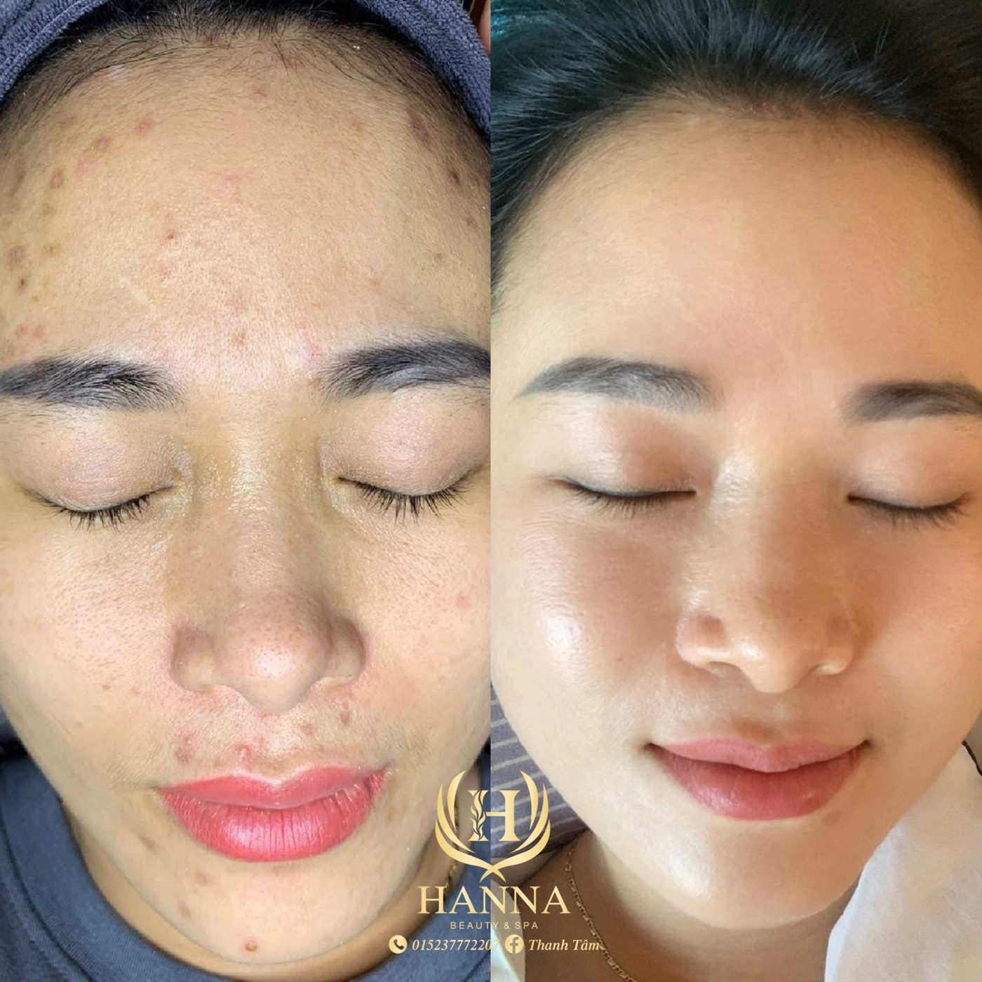 Khuôn mặt khách hàng trước và sau liệu trình: thâm mụn, mụn ẩn đã được cải thiện, da trong và mịn hơn