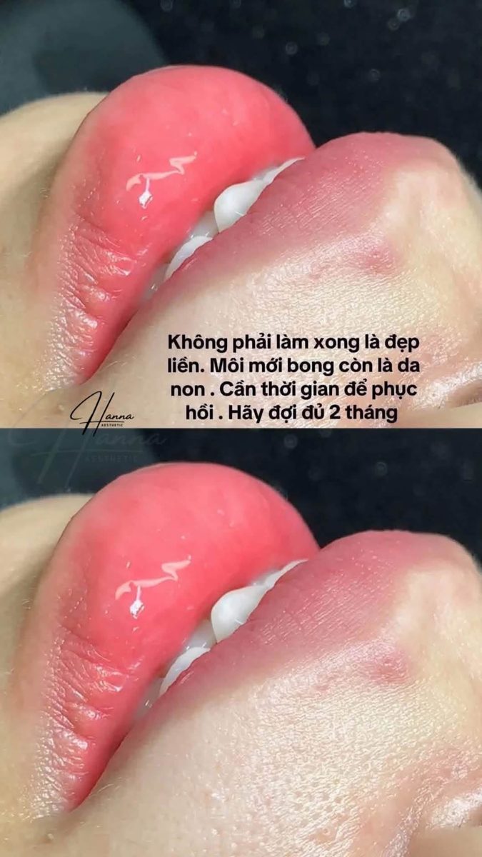Môi sau phun đang trong giai đoạn bong, da non còn hồng